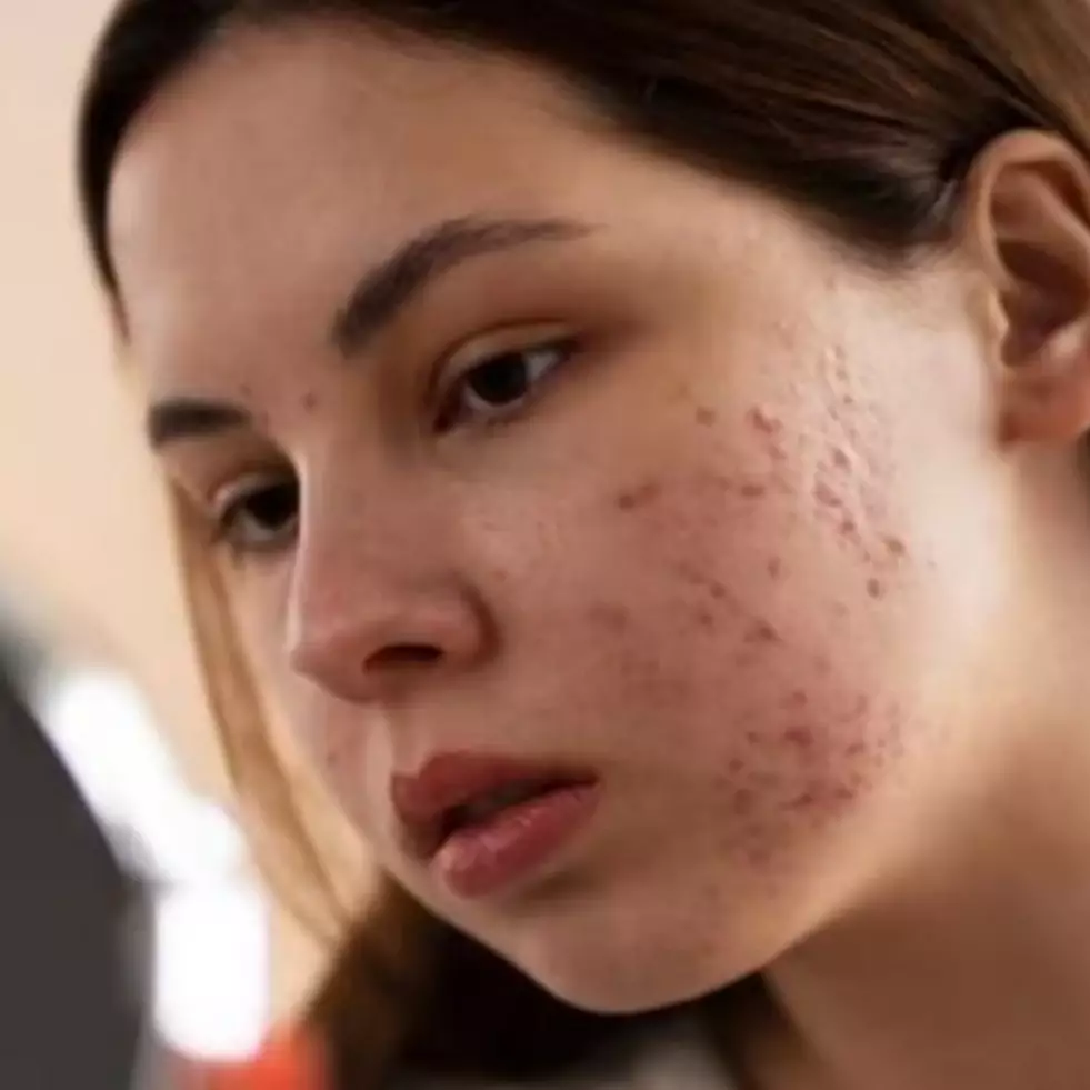 Tanpa kunyit dan kopi, ini cara hilangkan bekas jerawat menghitam pakai 1 jenis umbi-umbian