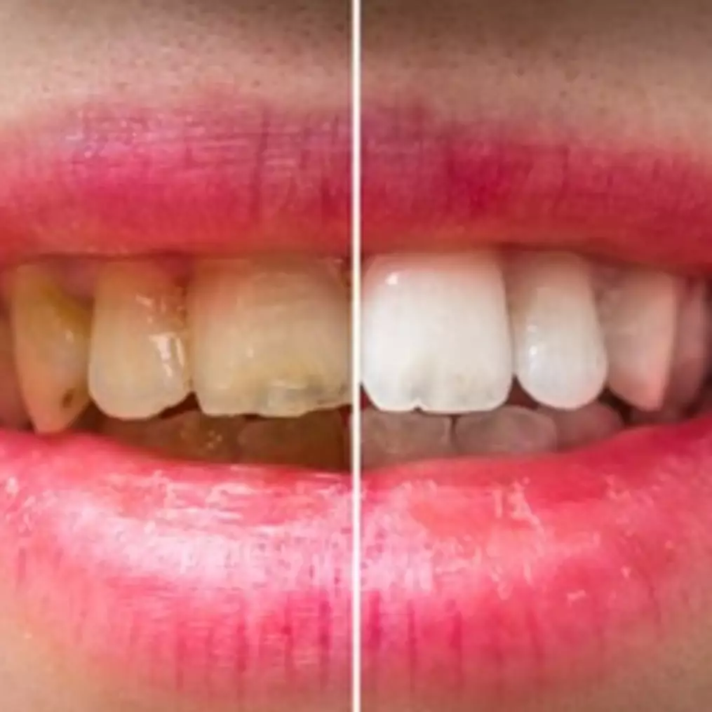 Tanpa kunyit, ini trik mencerahkan gigi kuning akibat plak membandel pakai 1 bahan alami