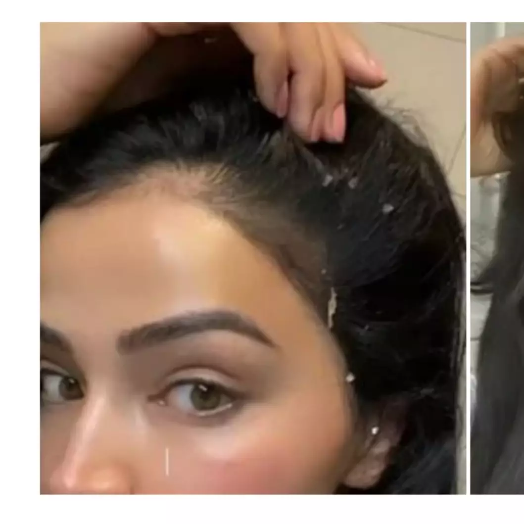 Bukan pakai cuka apel dan lemon, ini cara hempaskan ketombe berkerak pakai 1 jenis daun penyedap