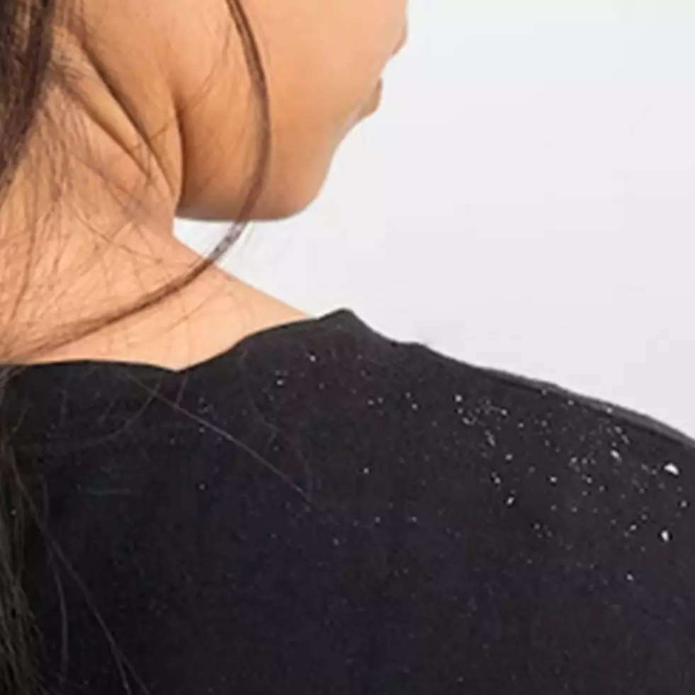 Tanpa scrub baking soda, ini trik menghilangkan ketombe membandel pakai 1 jenis karbohidrat