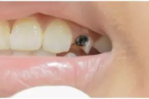 Bukan dengan baking soda, ini trik hilangkan gigi hitam agar kembali putih pakai 1 jenis biji-bijian