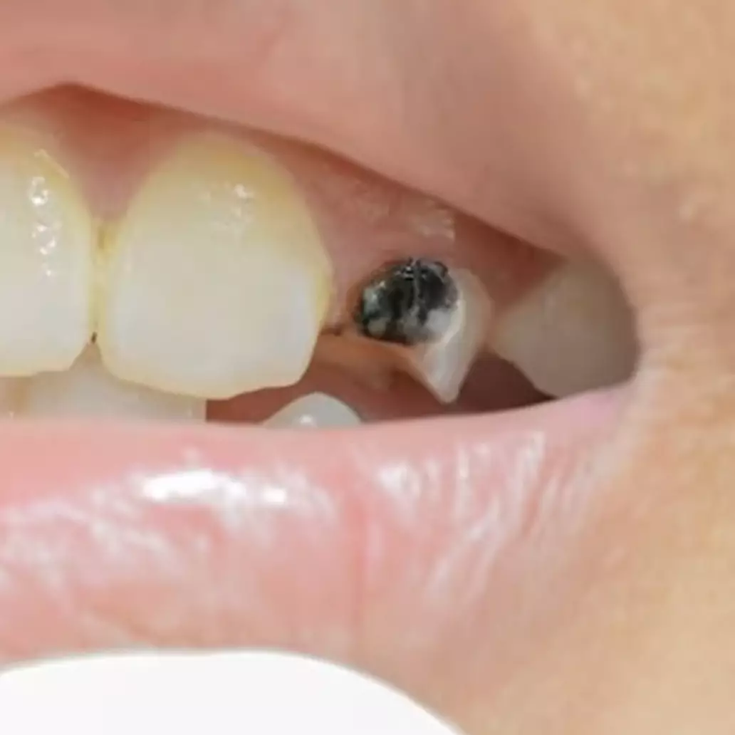 Bukan dengan baking soda, ini trik hilangkan gigi hitam agar kembali putih pakai 1 jenis biji-bijian