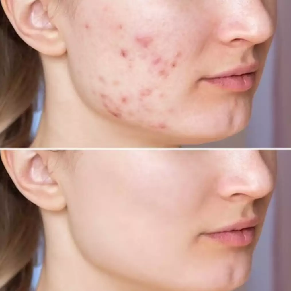 Tak hanya madu, ini trik meredakan radang jerawat di wajah pakai tambahan 1 jenis buah