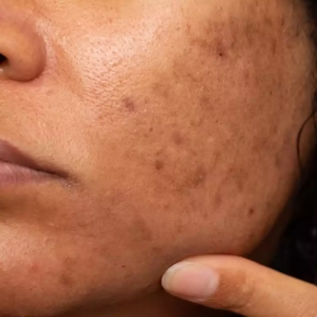 Tanpa kentang atau lemon, ini cara mencerahkan wajah gelap akibat flek hitam pakai 1 bahan masakan