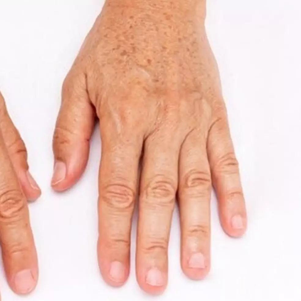 Bukan dengan lidah buaya, ini cara pudarkan bercak hitam pada tangan pakai 1 jenis protein