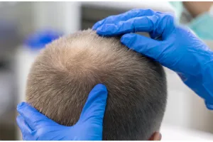 Tanpa jintan hitam, begini trik menumbuhkan rambut botak agar tumbuh lebat hanya pakai 1 jenis tanaman