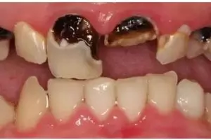 Tanpa garam, ini rontokkan plak hitam menempel di gigi agar auto bersih pakai 1 jenis rempah