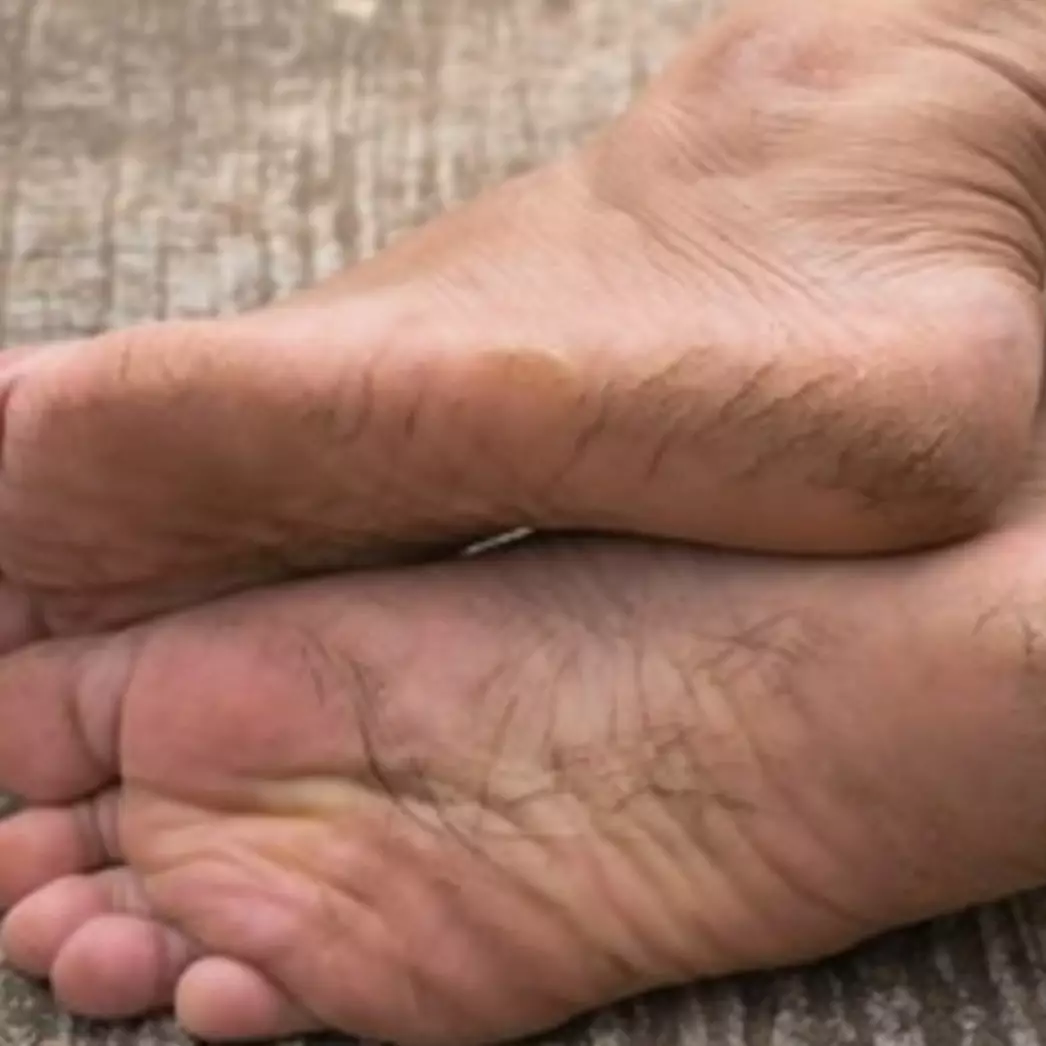 Tak hanya aloe vera, ini trik atasi telapak kaki hitam akibat pecah-pecah pakai 1 bahan pemanis