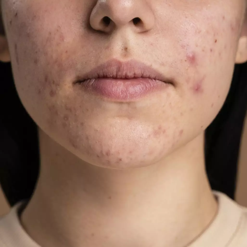 Bukan hanya kunyit, ini trik mudah mencerahkan noda hitam di wajah pakai pembersih dari 1 jenis sayur