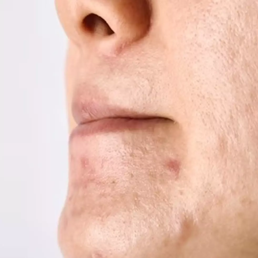 Tanpa kopi, ini cara menghaluskan kulit bertekstur agar auto mulus pakai 1 jenis kacang-kacangan