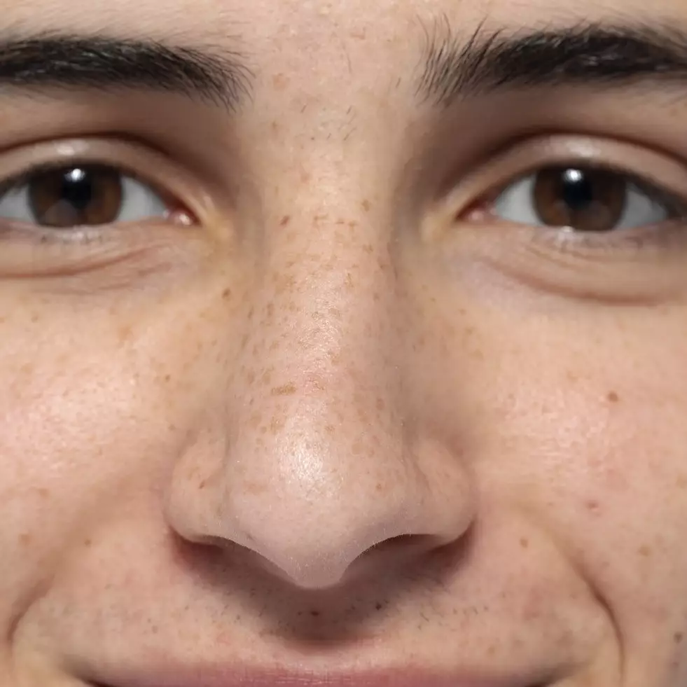 Tak perlu garam &amp; madu, ini cara lenyapkan hiperpigmentasi penyebab muka kusam pakai 1 bahan makanan