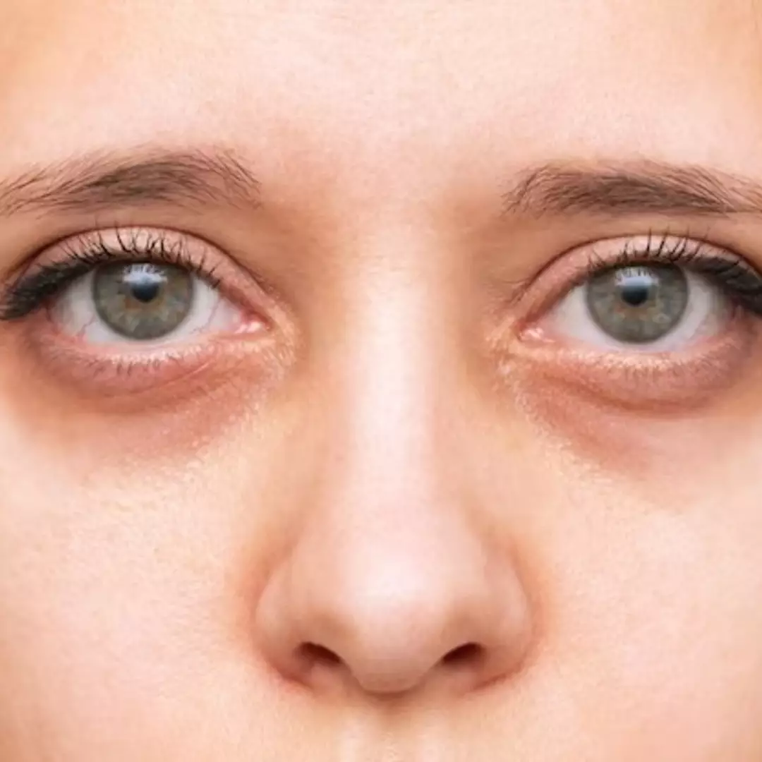 Tanpa timun, ini trik hilangkan kerutan dan lingkaran hitam di bawah mata pakai 2 jenis minyak alami