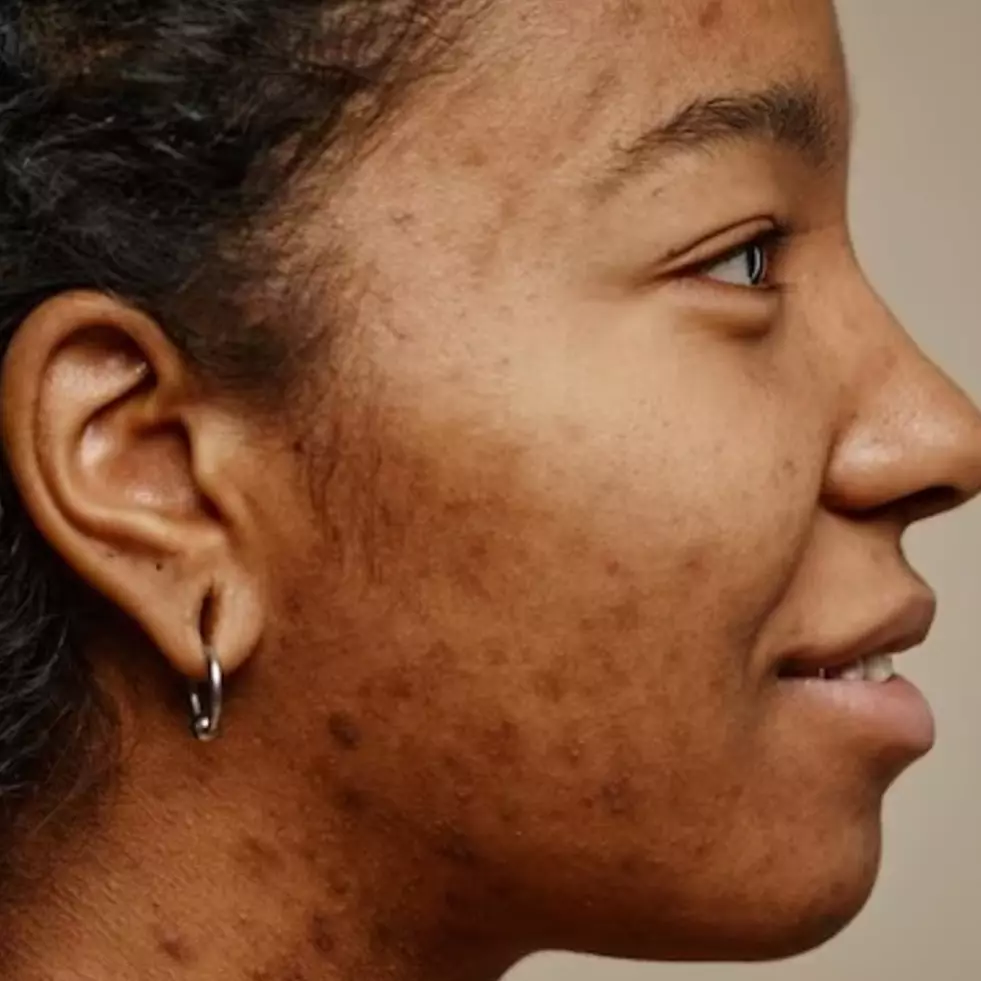 Tanpa kunyit, ini cara memutihkan kulit penuh flek hitam akibat panas matahari pakai 1 jenis minuman