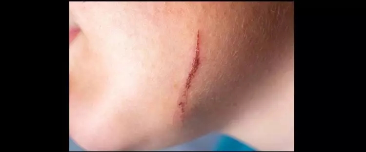 Tak perlu cuka sari apel, ini cara mudah hilangkan bekas luka di wajah hanya pakai 1 jenis biji-bijian