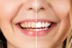 Tanpa garam dan lemon, ini trik memutihkan gigi kuning akibat sisa makanan pakai 1 jenis bahan dapur