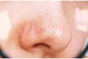 Tak perlu pasta gigi dan garam, ini cara atasi komedo hitam hanya pakai 1 jenis rempah