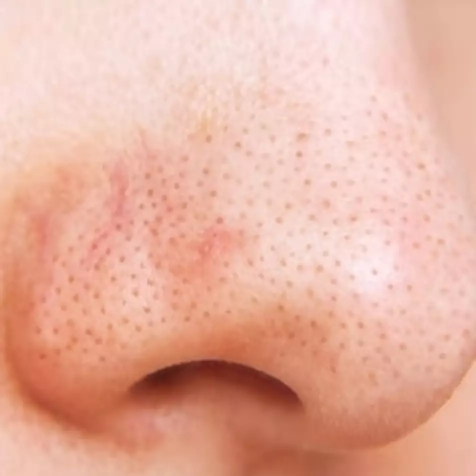 Tak perlu pasta gigi dan garam, ini cara atasi komedo hitam hanya pakai 1 jenis rempah