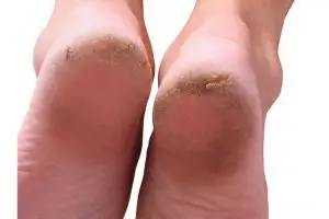 Tak perlu petroleum jelly, ini cara memuluskan telapak kaki retak dan menghitam pakai 1 bahan pemanis