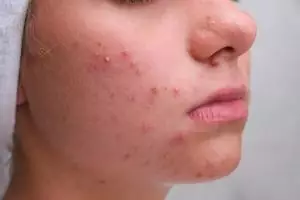 Tak perlu clay mask, ini trik atasi kulit penuh beruntusan akibat jerawat dengan 1 produk fermentasi