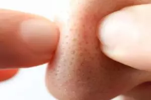 Tanpa lemon dan kopi, ini cara bersihkan pori-pori tersumbat penyebab komedo pakai 1 jenis tepung