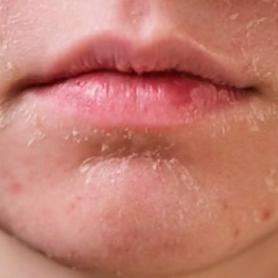 Jangan dikopek, ini trik atasi kulit kering mengelupas pakai 1 jenis daun