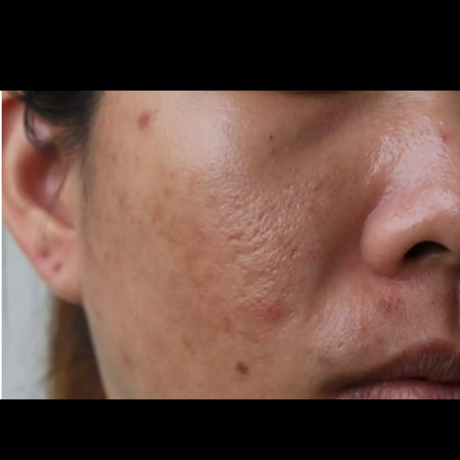 Tanpa air mawar, ini cara atasi kulit mengilap akibat minyak berlebih pakai 1 jenis tepung