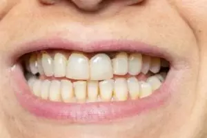 Tanpa garam dan kunyit, ini trik hilangkan noda kuning bekas makanan pada gigi pakai 1 jenis minyak