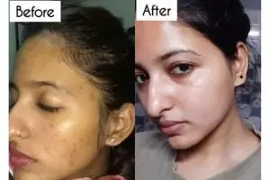 Bukan pakai timun, ini trik bikin jerawat dan bekasnya cepat hilang dengan 1 jenis umbi-umbian