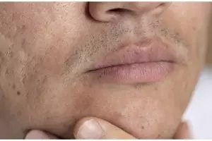 Tanpa scrub gula, ini cara bersihkan pori-pori wajah tersumbat agar tak jerawatan pakai 1 bahan alami