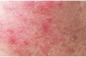 Bukan dengan lidah buaya, ini cara atasi kulit wajah iritasi akibat jerawat pakai 1 jenis bunga