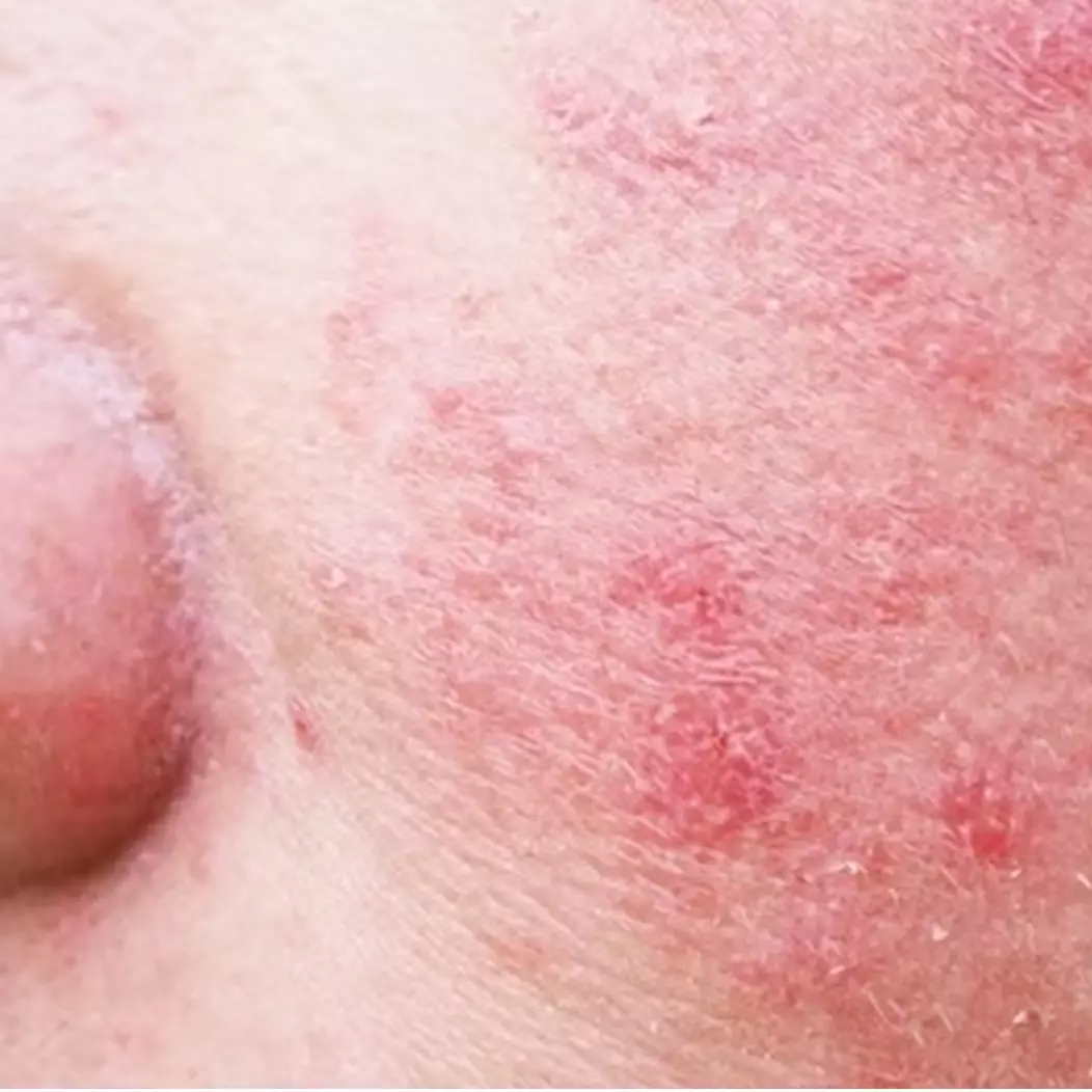 Bukan dengan lidah buaya, ini cara atasi kulit wajah iritasi akibat jerawat pakai 1 jenis bunga