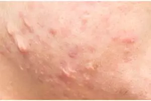 Tanpa putih telur, ini cara bersihkan wajah dari jerawat pakai 1 jenis daun