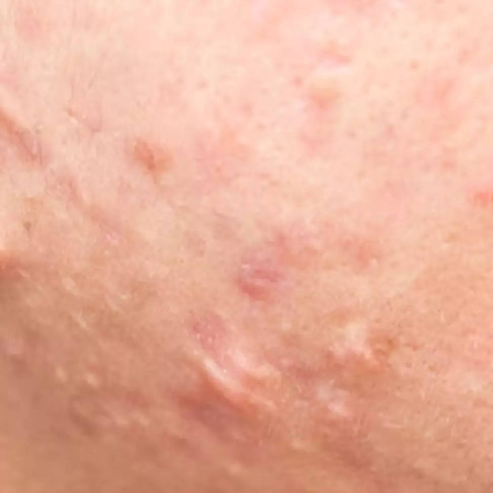 Tanpa putih telur, ini cara bersihkan wajah dari jerawat pakai 1 jenis daun