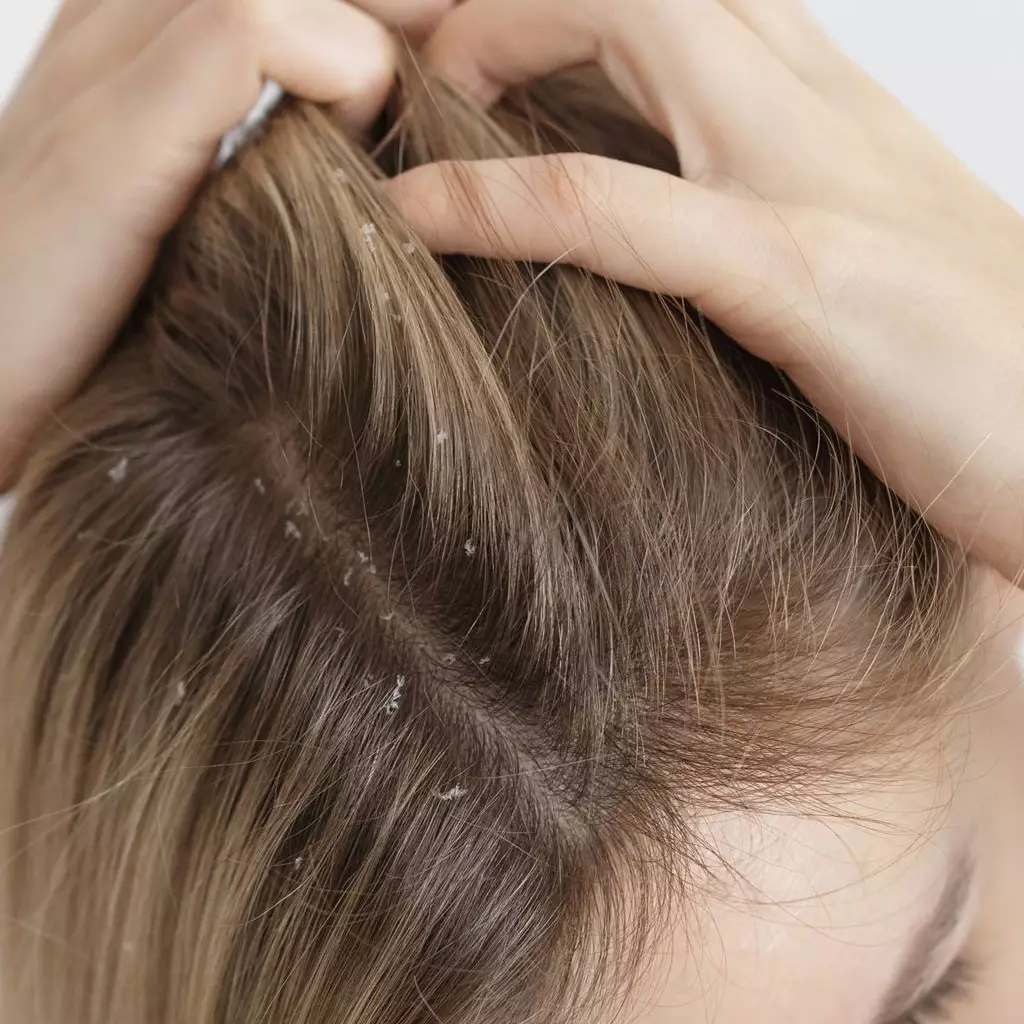 Tanpa lemon, ini cara redakan gatal pada kulit kepala akibat ketombe hanya pakai 2 jenis biji-bijian