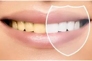 Tanpa kumur pakai minyak kelapa, ini trik pudarkan noda kuning di gigi gunakan 1 bahan dapur