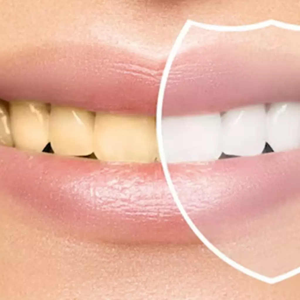 Tanpa kumur pakai minyak kelapa, ini trik pudarkan noda kuning di gigi gunakan 1 bahan dapur