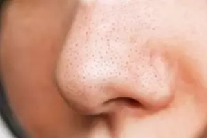 Nggak perlu tambahan lemon, ini trik angkat komedo hitam pada pipi dan hidung pakai 1 jenis bahan kue