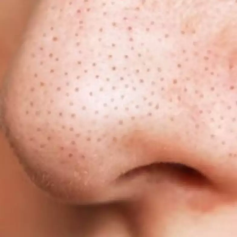 Nggak perlu tambahan lemon, ini trik angkat komedo hitam pada pipi dan hidung pakai 1 jenis bahan kue