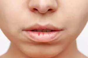 Bukan dengan madu, ini cara lembutkan bibir retak mengelupas dan hitam pakai 1 jenis produk pelembap