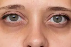 Tanpa kunyit dan mentimun, begini trik pudarkan dark circle dan mata bengkak pakai 1 jenis kulit buah