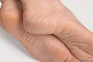 Tak perlu tambahan minyak zaitun, ini cara kembalikan tumit retak jadi halus dengan 1 jenis tepung