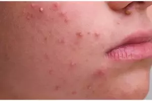 Nggak perlu pakai lemon, ini cara hilangkan jerawat meradang pakai face wash dari 1 jenis daun