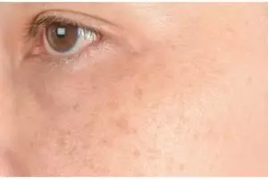 Hasilnya terlihat kurang dari seminggu, ini cara cerahkan pigmentasi pada wajah pakai 1 bahan makanan