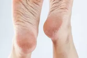 Nggak hanya petroleum jelly, ini trik haluskan tumit retak dengan tambahan 1 jenis buah-buahan