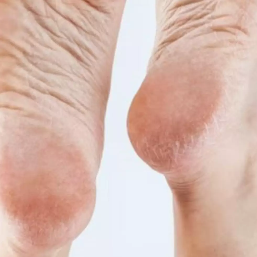 Nggak hanya petroleum jelly, ini trik haluskan tumit retak dengan tambahan 1 jenis buah-buahan