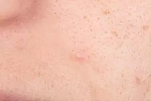 Tanpa tambahan kopi, begini trik hilangkan komedo membandel pada pipi pakai 1 jenis buah-buahan