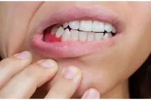 Tak perlu treatment di dokter gigi, ini cara atasi gusi hitam pakai 1 bahan minuman