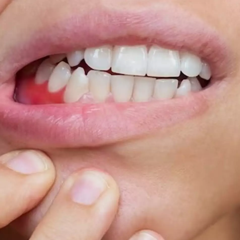 Tak perlu treatment di dokter gigi, ini cara atasi gusi hitam pakai 1 bahan minuman