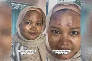Minder jerawatan di hari pernikahan, pengantin dirias MUA jadi mulus ini cantiknya bikin melongo