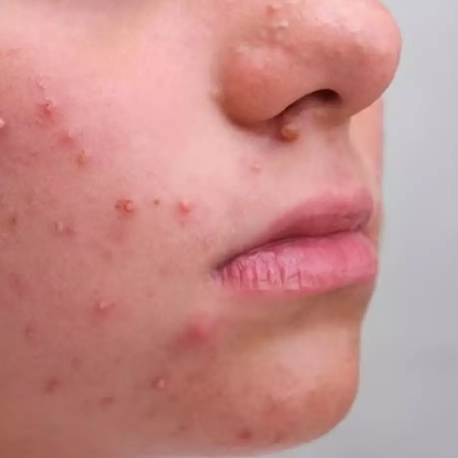 Tanpa daun neem, ini trik redam rasa sakit dan kempeskan jerawat meradang pakai 1 jenis teh